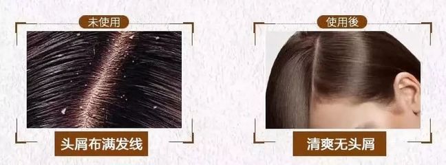 告別脫發(fā)、頭皮屑與頭發(fā)稀少的煩惱，重塑烏黑濃密的秀發(fā)